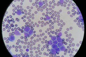 Patient with elevated white blood cells caused by leukaemia
